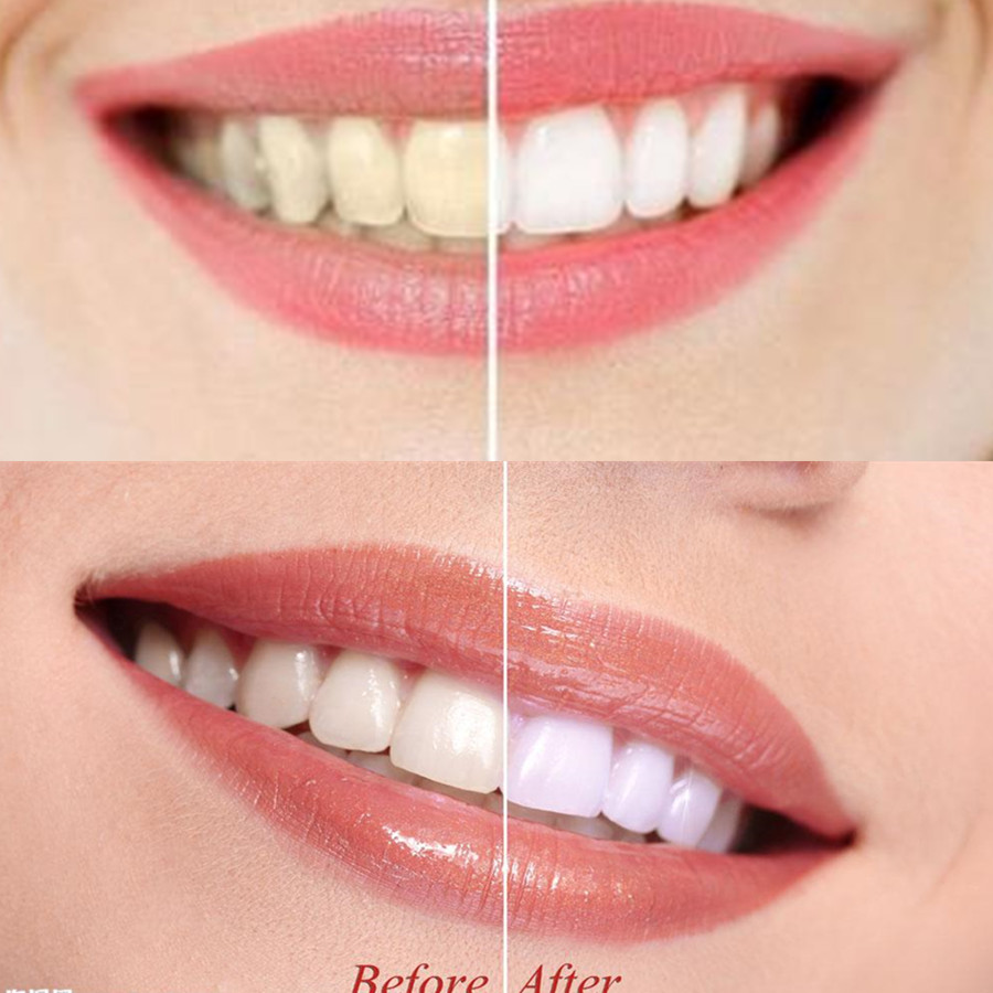 Bambu kömür diş diş diş hekimi - Teeth Whitening Ulta incelemesi ve fiyatı