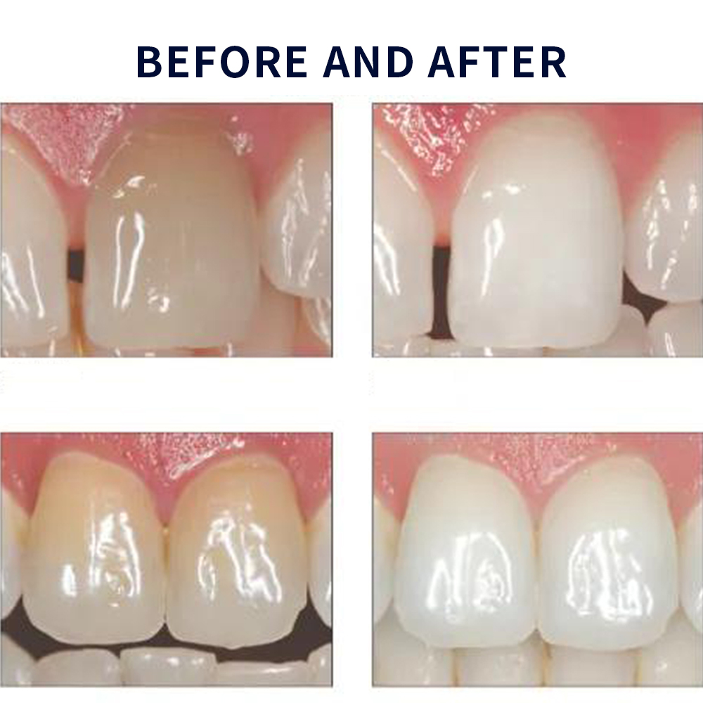 Opalescence beyazlatma 20% PF  - Teeth Whitening Ulta incelemesi ve fiyatı